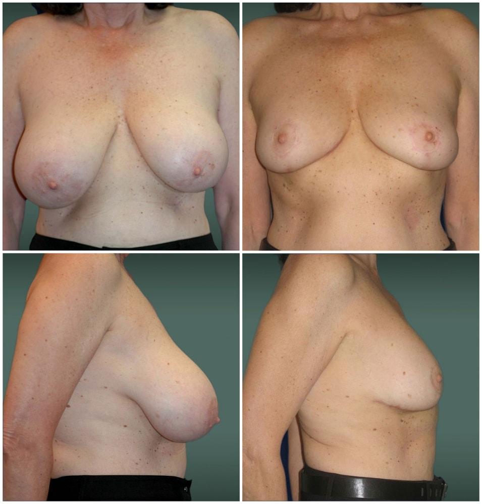 Mark H. Schwartz, MD, FACS breast reduction result — New York, NY