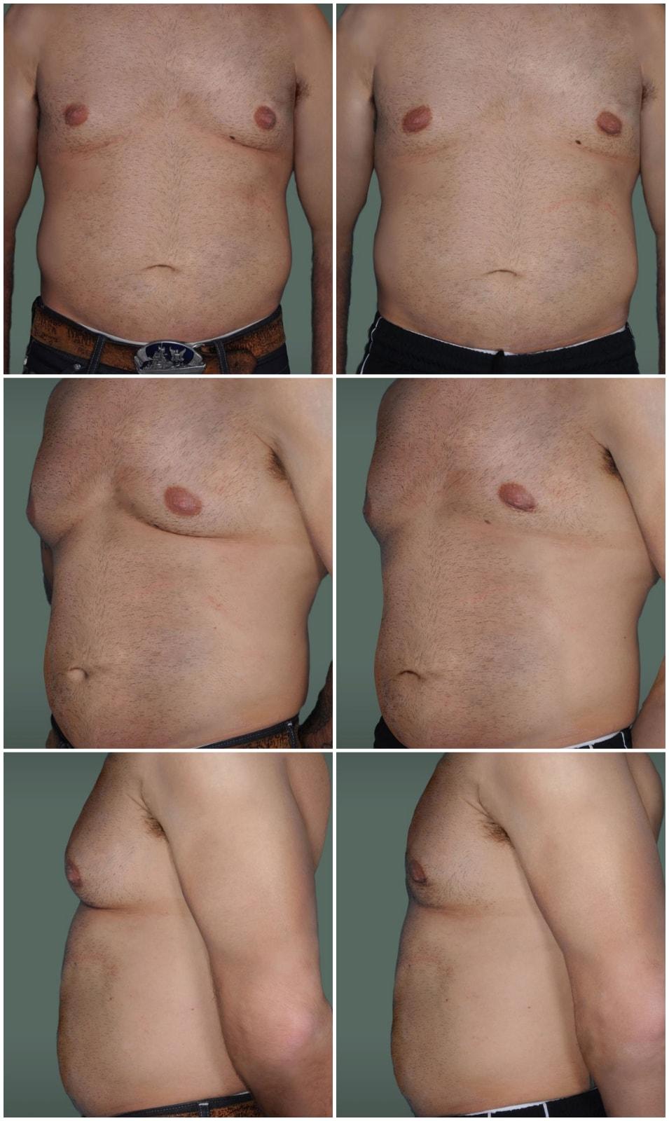 Mark H. Schwartz, MD, FACS gynecomastia result — New York, NY