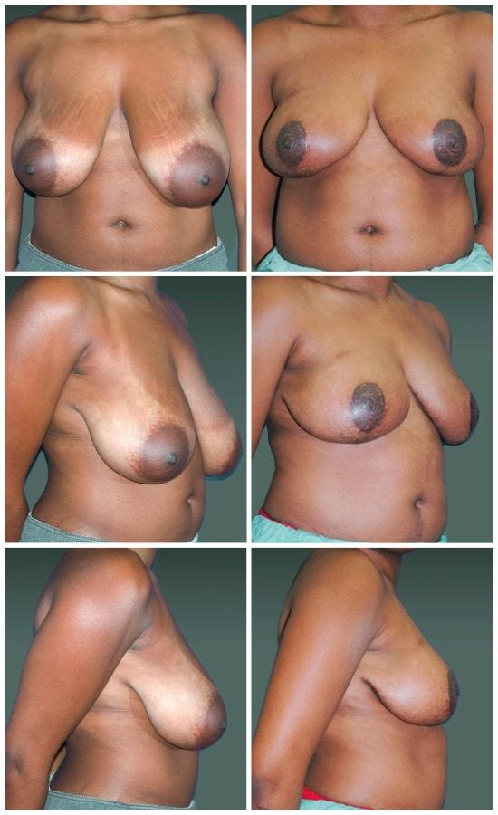 Mark H. Schwartz, MD, FACS breast reduction result — New York, NY