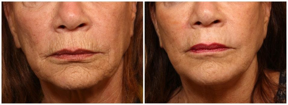 Mark H. Schwartz, MD, FACS laser treatment result — New York, NY