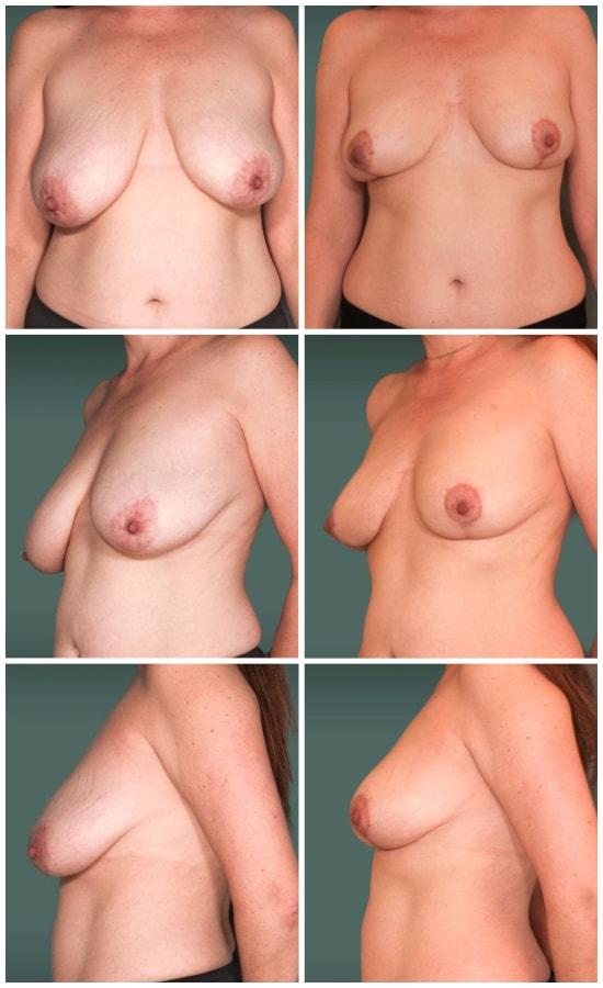 Mark H. Schwartz, MD, FACS breast reduction result — New York, NY
