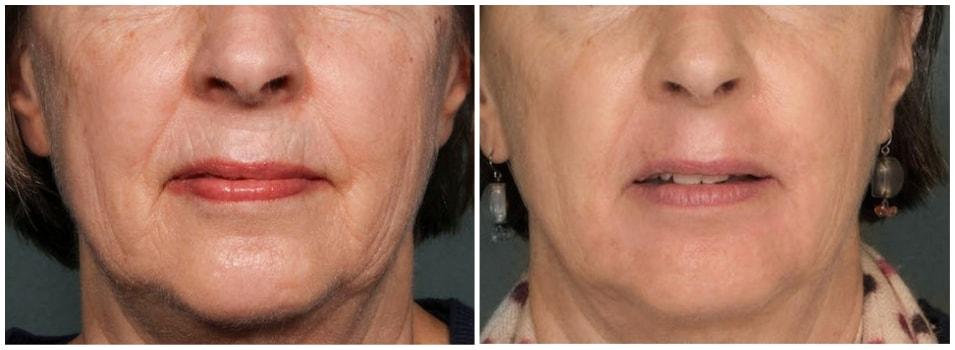 Mark H. Schwartz, MD, FACS laser treatment result — New York, NY