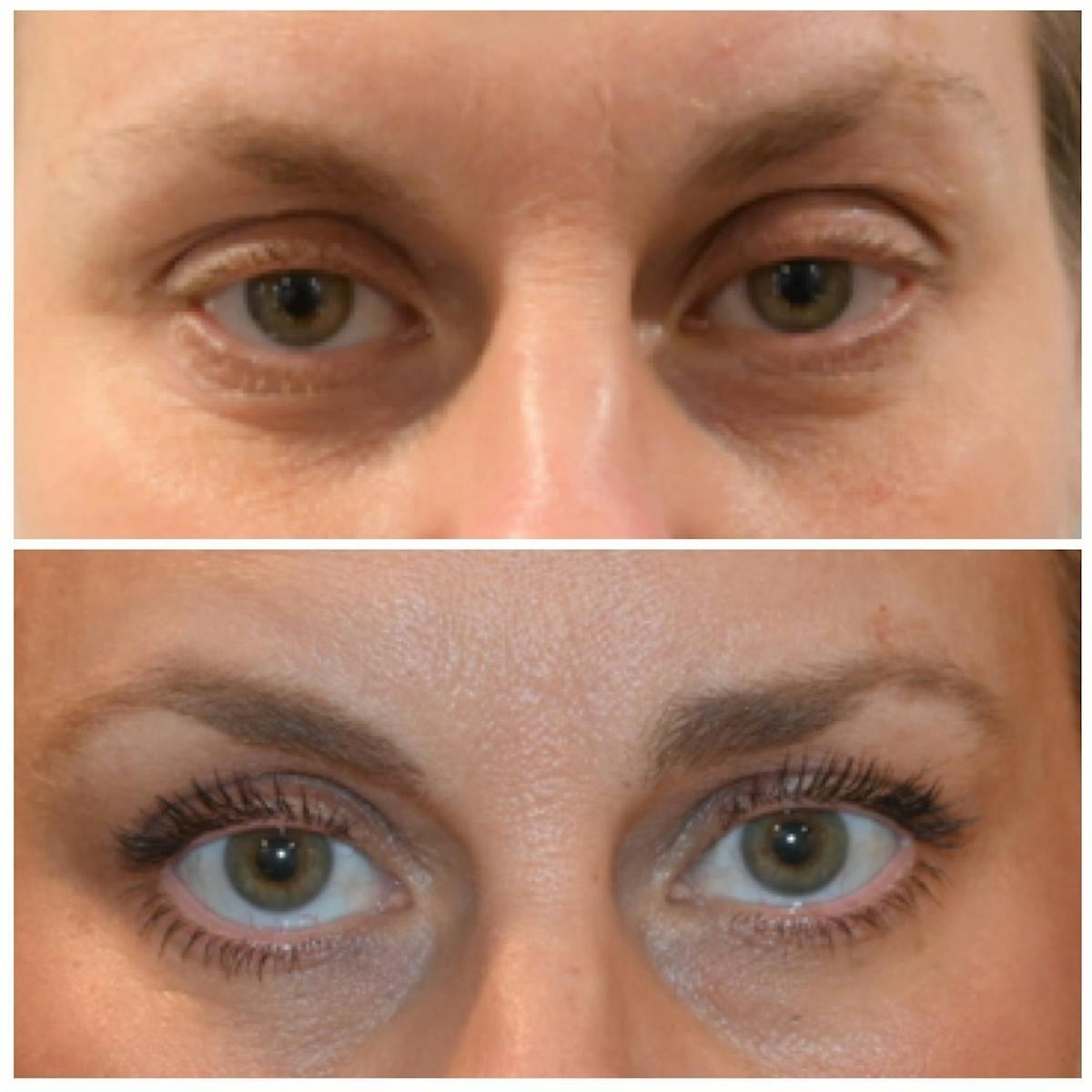 Dr. Brian Shafa Plastic Surgery blepharoplasty result — Beverly Hills, CA