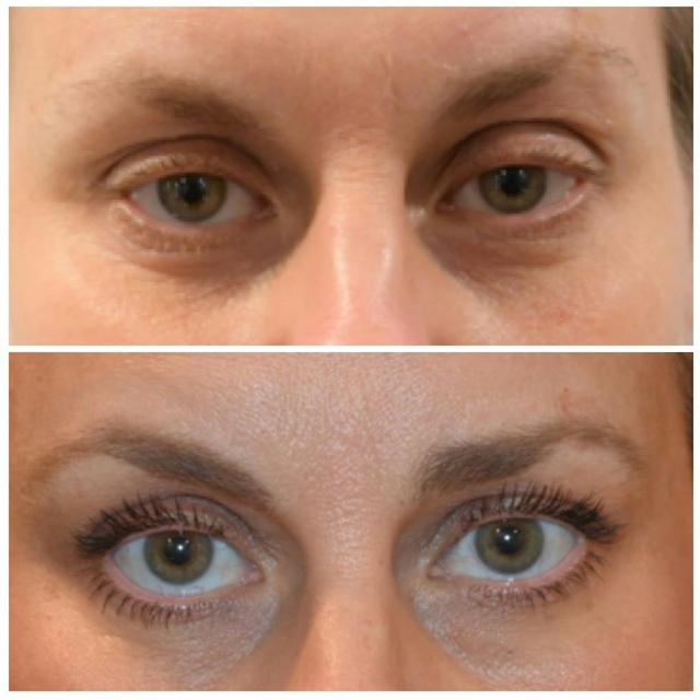 Blepharoplasty result at Dr. Brian Shafa Plastic Surgery in Beverly Hills, CA
