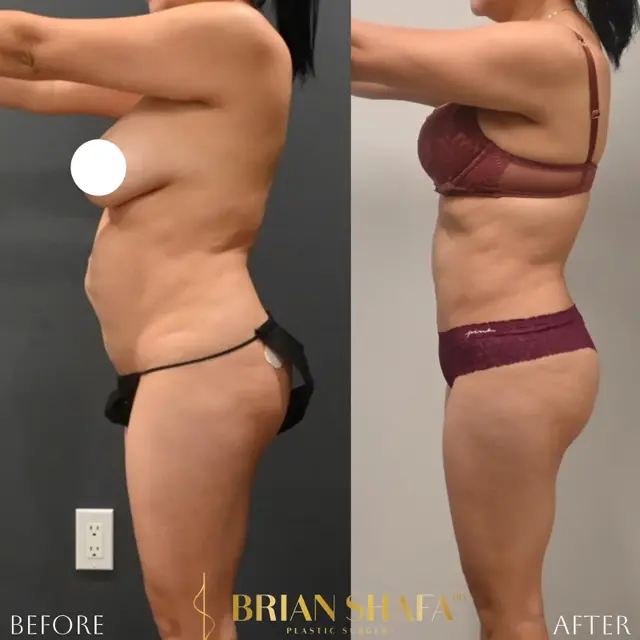 Mini Tummy Tuck result at Dr. Brian Shafa Plastic Surgery in Beverly Hills, CA