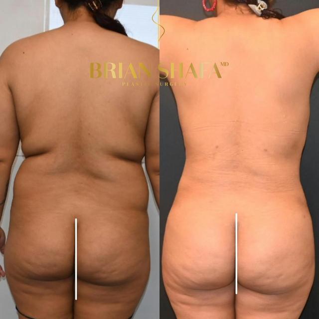 Brazilian Butt Lift result at Dr. Brian Shafa Plastic Surgery in Beverly Hills, CA