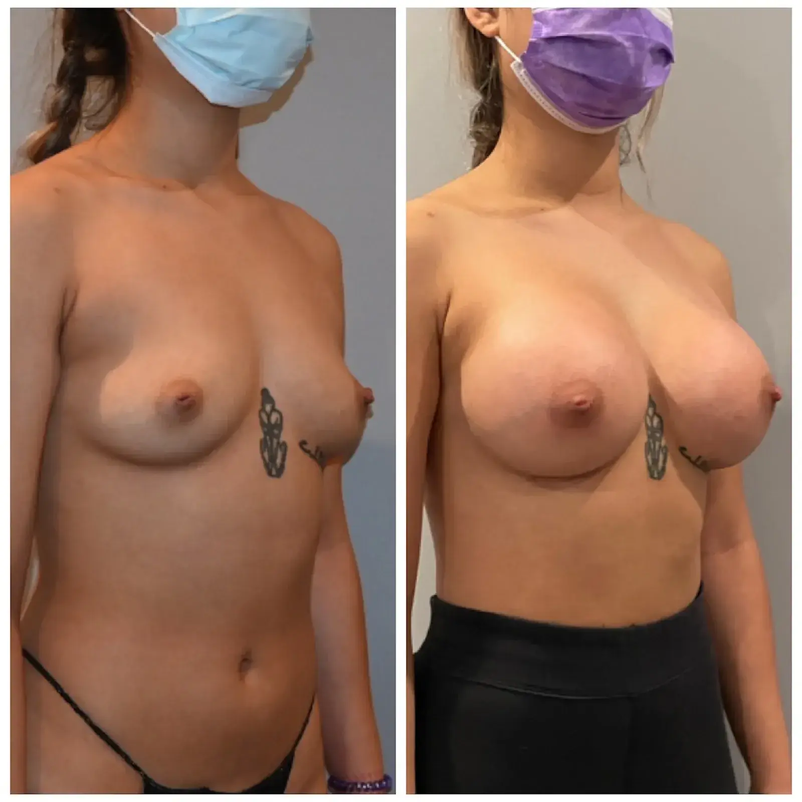 Dr. Brian Shafa Plastic Surgery breast augmentation result — Beverly Hills, CA