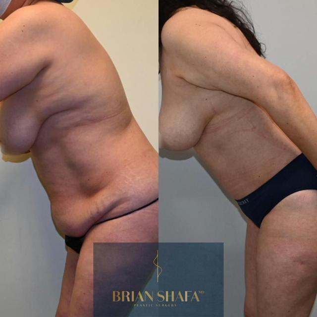 Mommy Makeover result at Dr. Brian Shafa Plastic Surgery in Beverly Hills, CA
