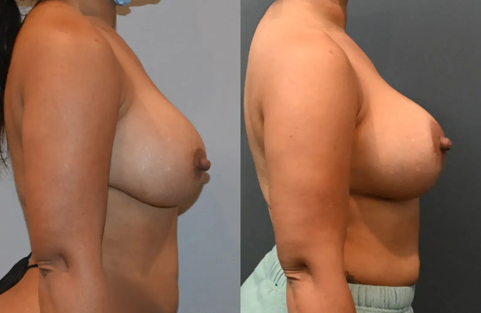 Dr. Brian Shafa Plastic Surgery breast lift result — Beverly Hills, CA