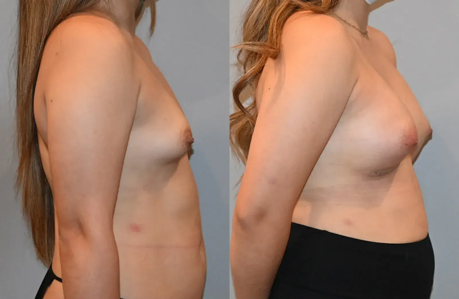 Dr. Brian Shafa Plastic Surgery breast augmentation result — Beverly Hills, CA