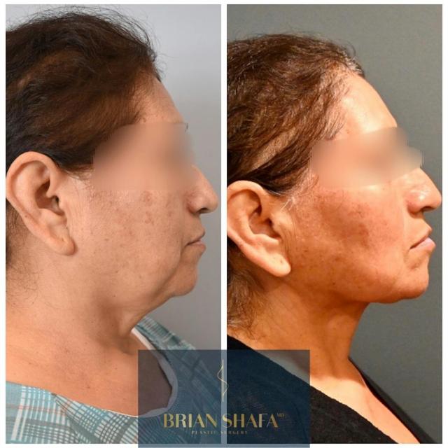 Facelift result at Dr. Brian Shafa Plastic Surgery in Beverly Hills, CA