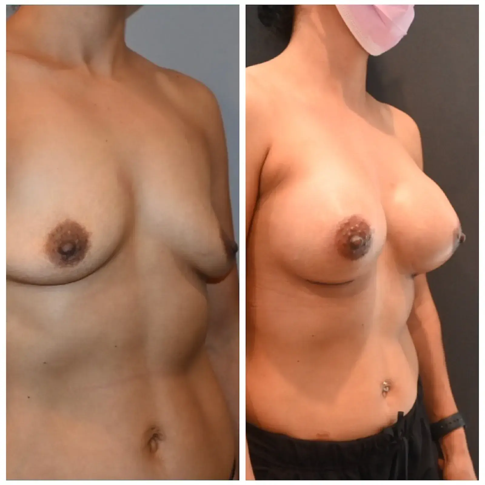 Dr. Brian Shafa Plastic Surgery breast augmentation result — Beverly Hills, CA