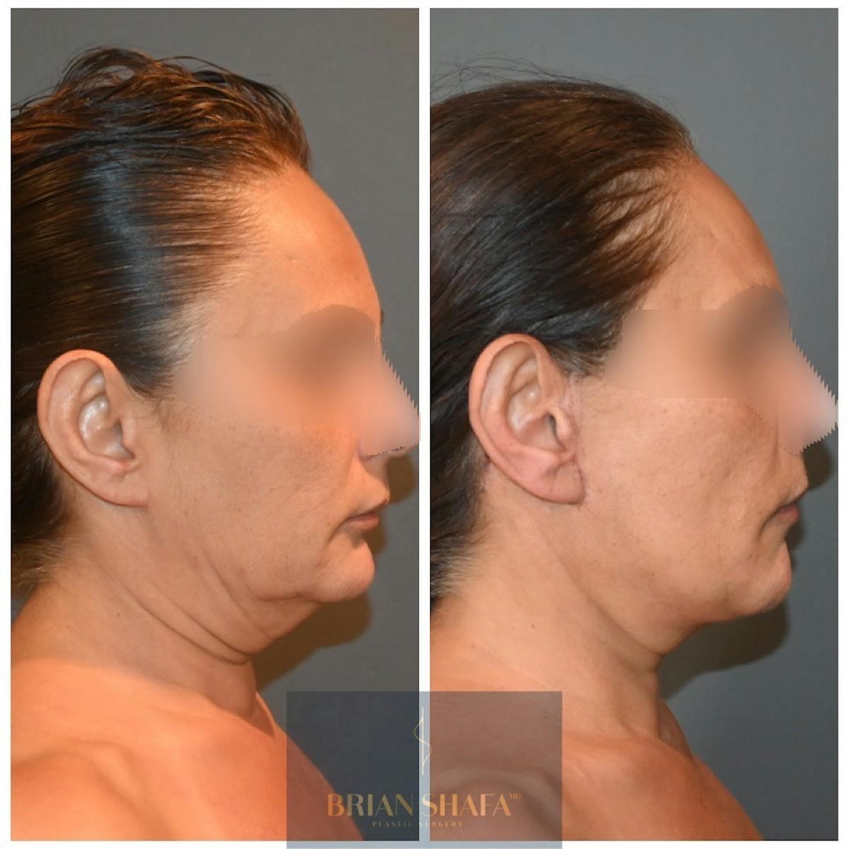 Dr. Brian Shafa Plastic Surgery facelift result — Beverly Hills, CA