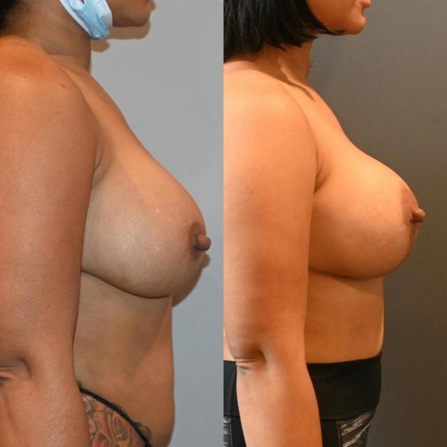 Breast Lift result at Dr. Brian Shafa Plastic Surgery in Beverly Hills, CA