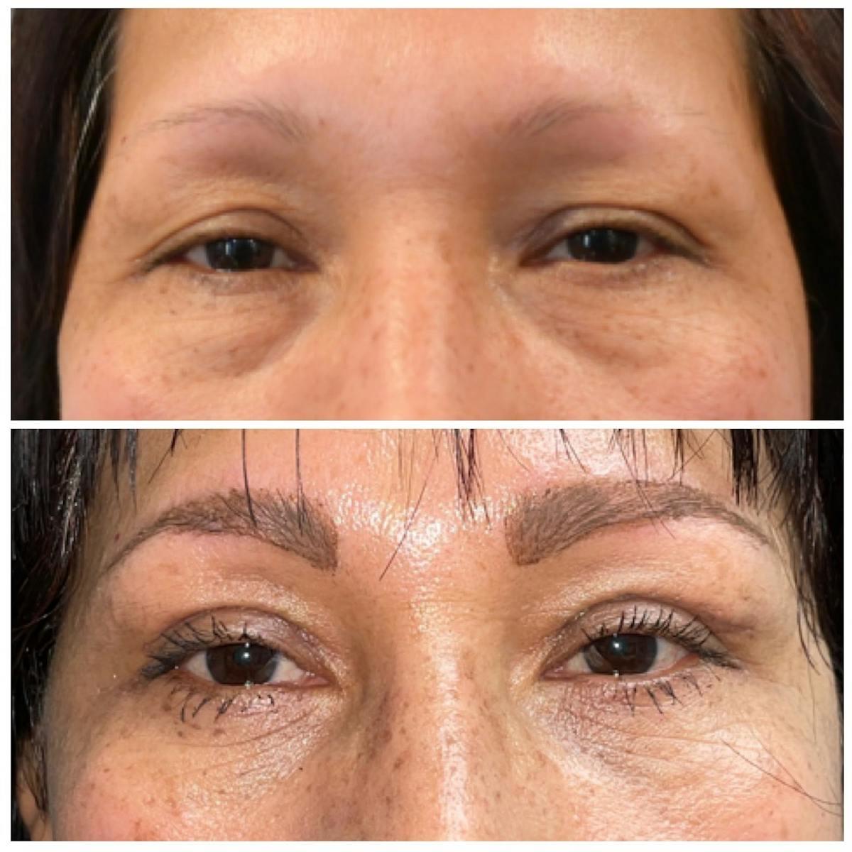 Dr. Brian Shafa Plastic Surgery blepharoplasty result — Beverly Hills, CA