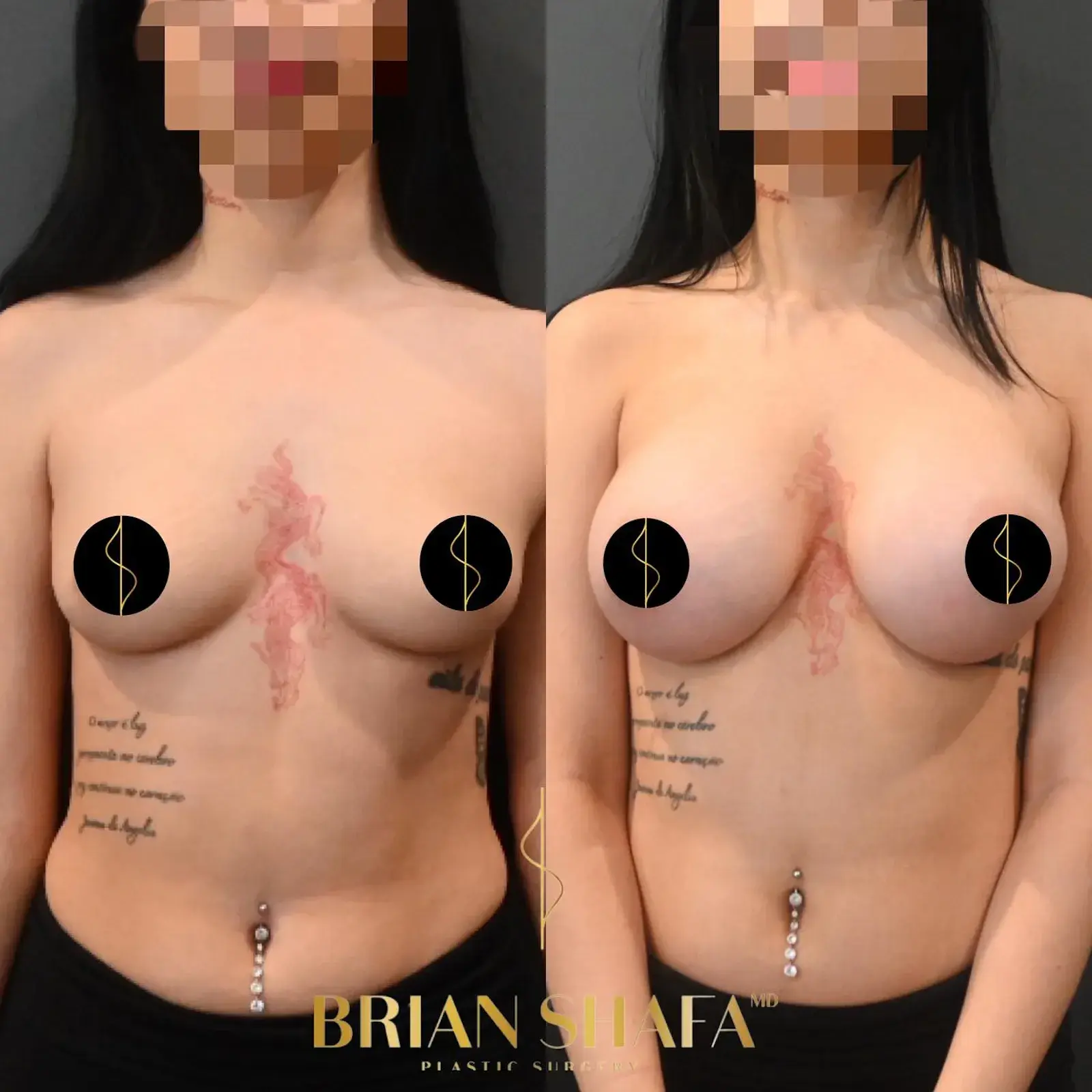 Dr. Brian Shafa Plastic Surgery breast augmentation result — Beverly Hills, CA