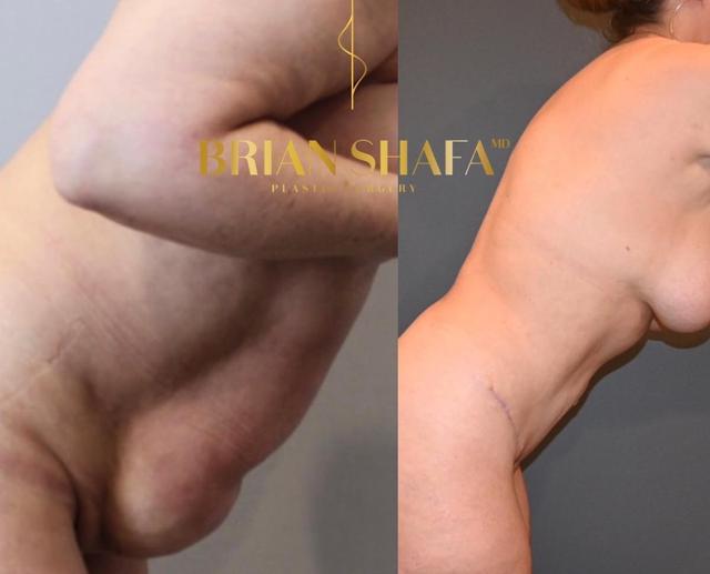 Tummy Tuck result at Dr. Brian Shafa Plastic Surgery in Beverly Hills, CA