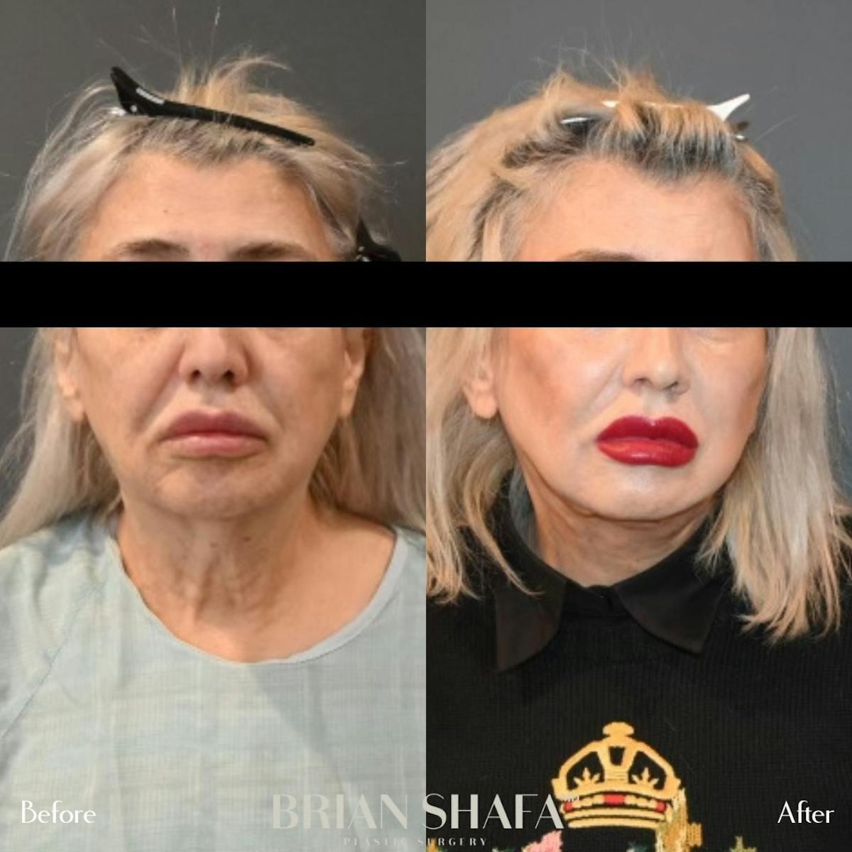 Dr. Brian Shafa Plastic Surgery facelift result — Beverly Hills, CA