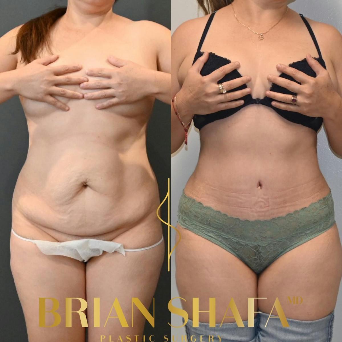 Dr. Brian Shafa Plastic Surgery tummy tuck result — Beverly Hills, CA