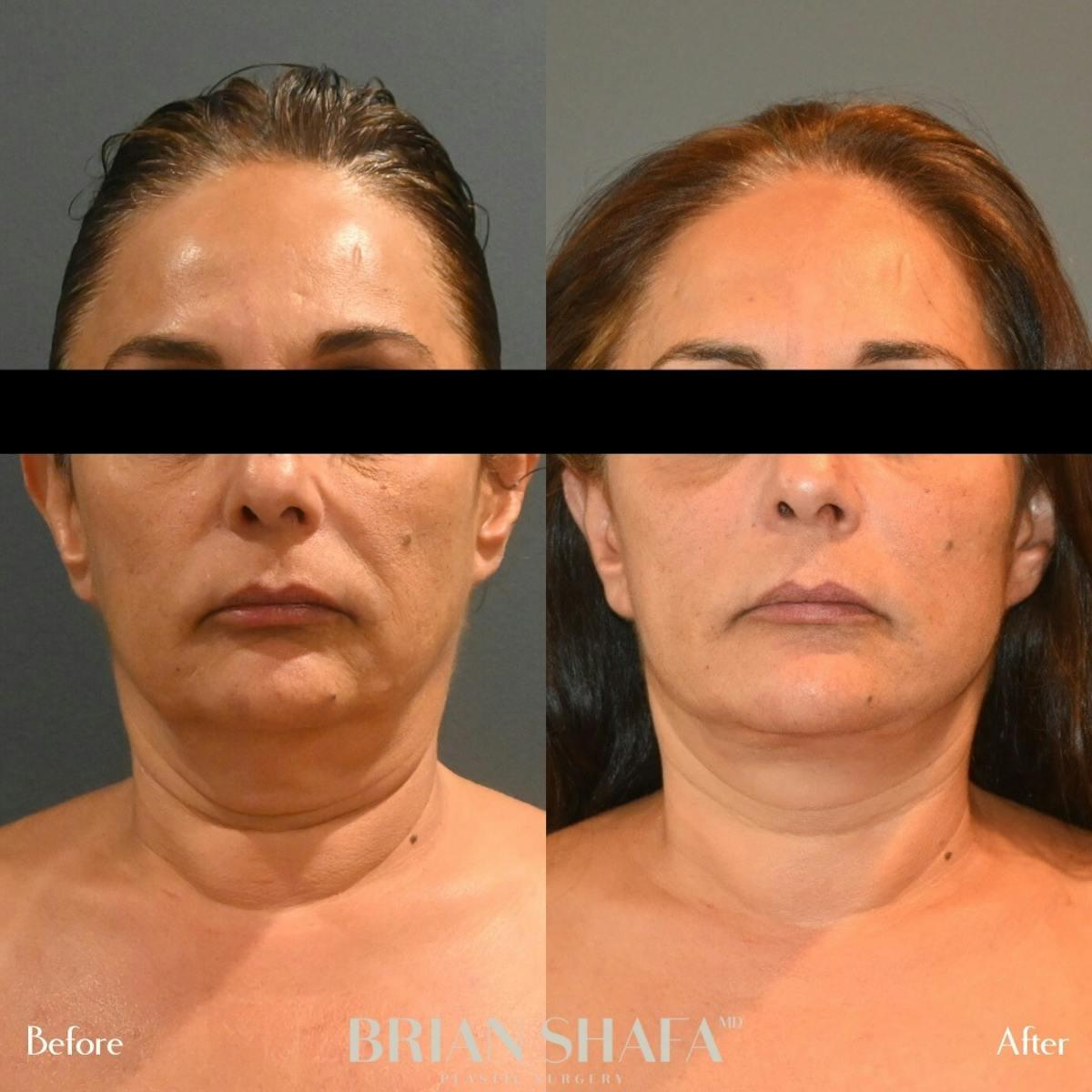 Dr. Brian Shafa Plastic Surgery facelift result — Beverly Hills, CA