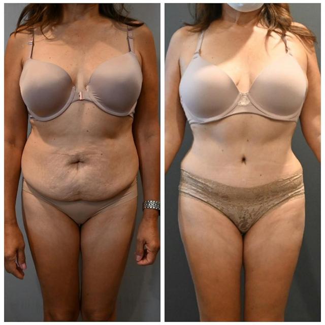 Tummy Tuck result at Dr. Brian Shafa Plastic Surgery in Beverly Hills, CA