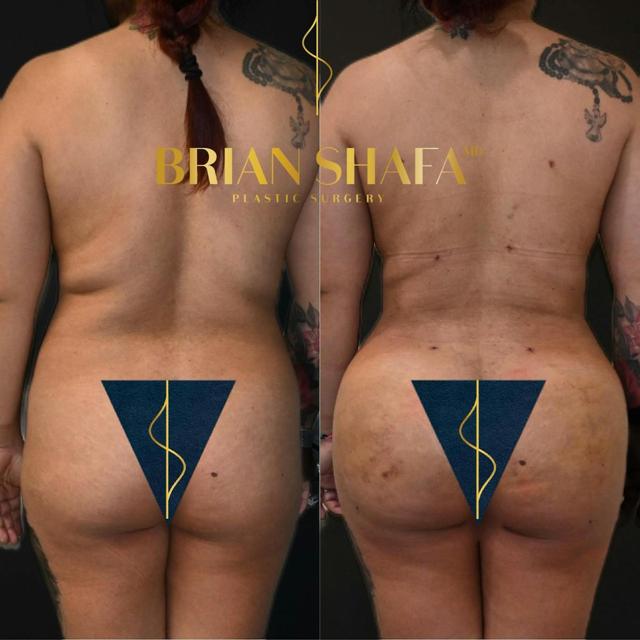 Brazilian Butt Lift result at Dr. Brian Shafa Plastic Surgery in Beverly Hills, CA