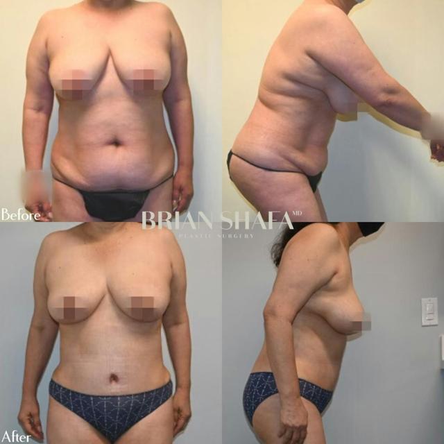 Mommy Makeover result at Dr. Brian Shafa Plastic Surgery in Beverly Hills, CA