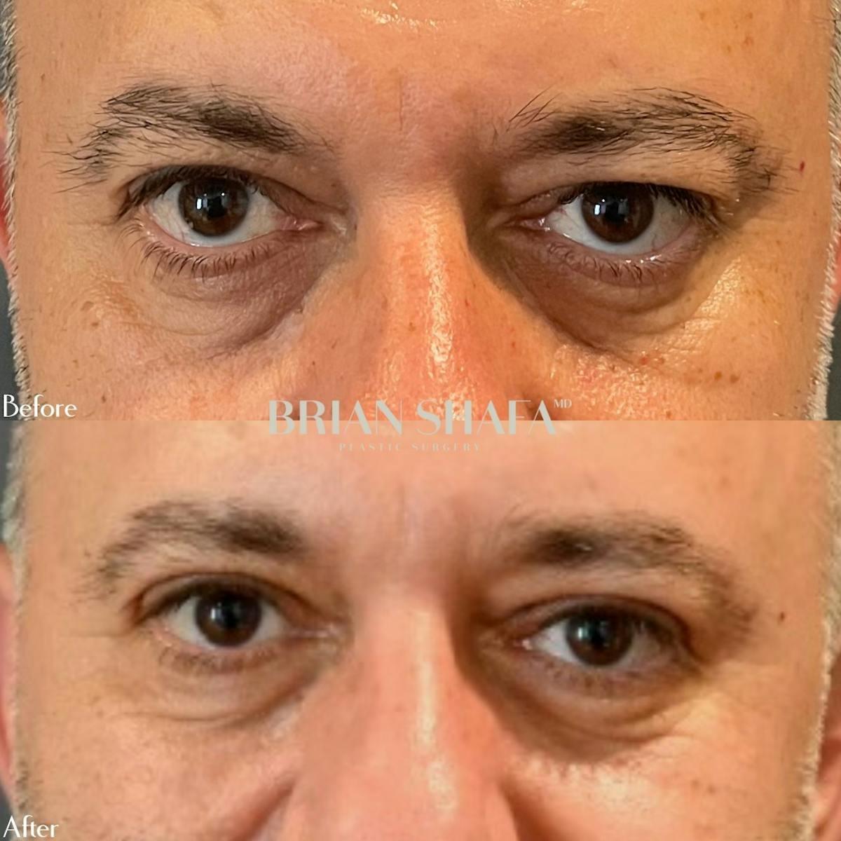 Dr. Brian Shafa Plastic Surgery blepharoplasty result — Beverly Hills, CA