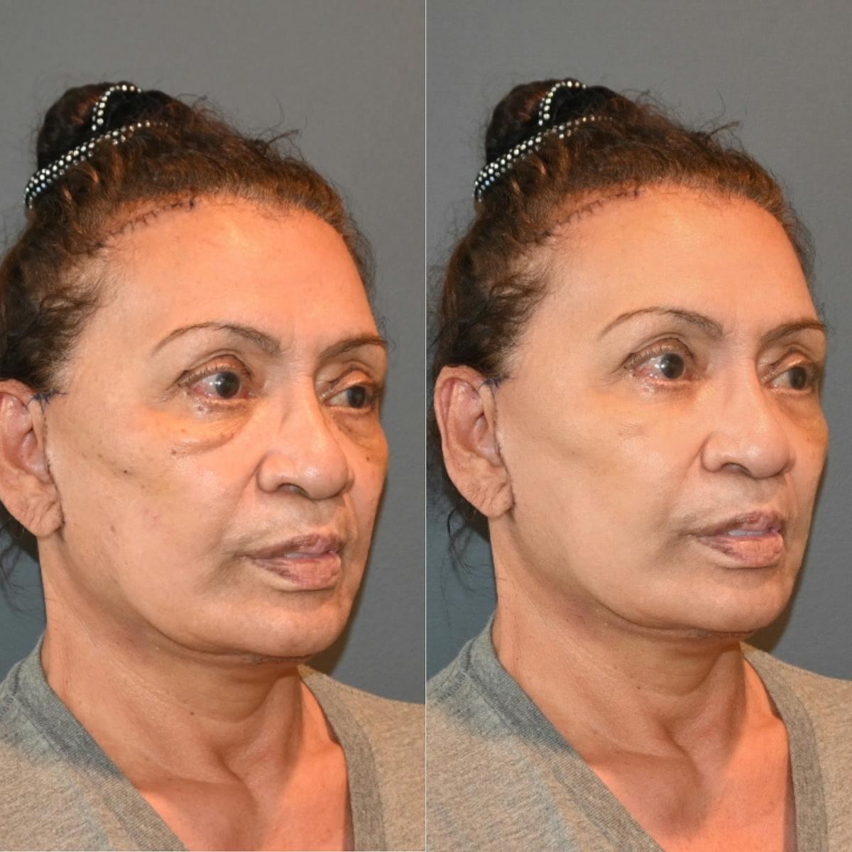 Dr. Brian Shafa Plastic Surgery facelift result — Beverly Hills, CA
