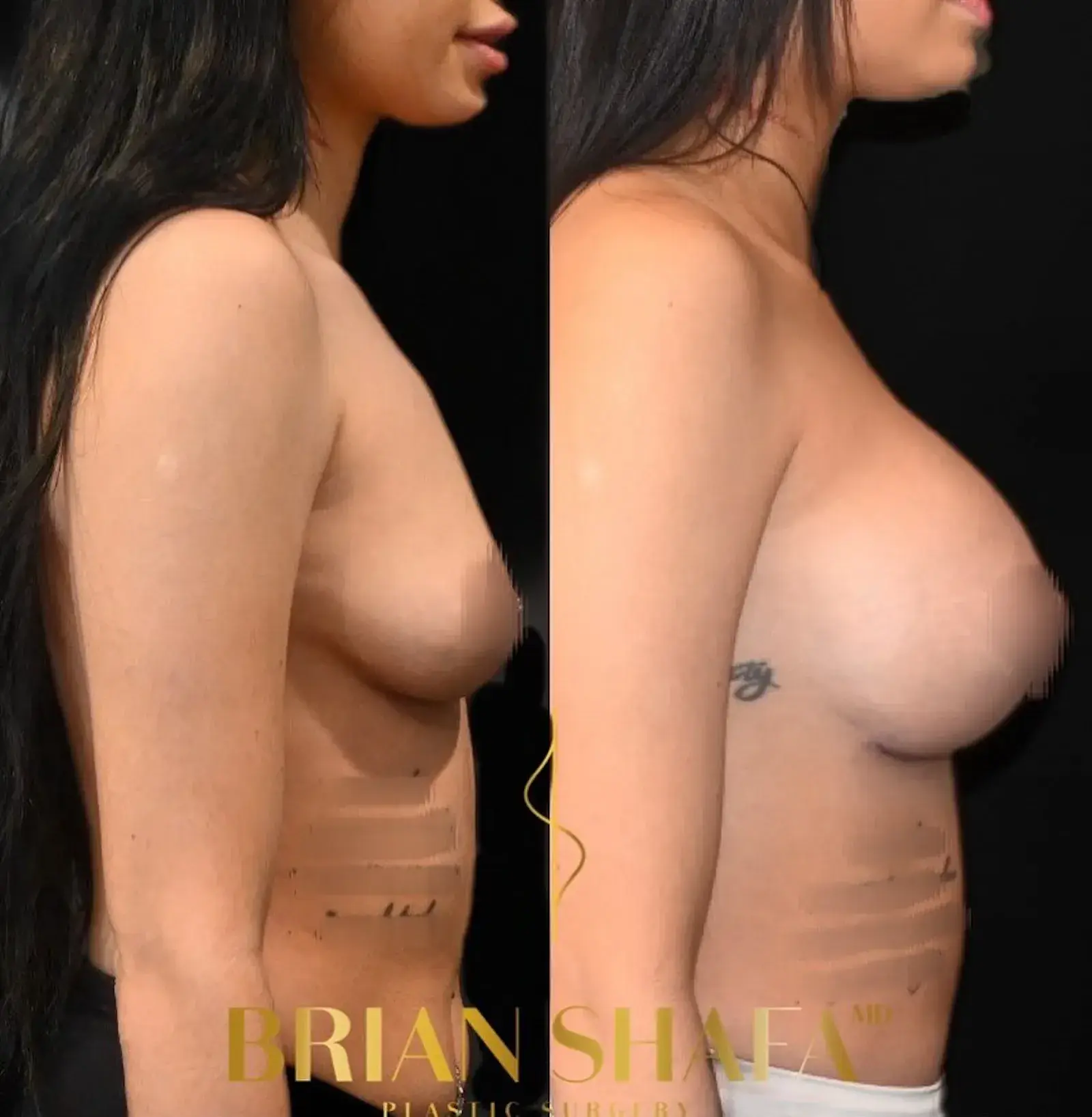 Dr. Brian Shafa Plastic Surgery breast augmentation result — Beverly Hills, CA