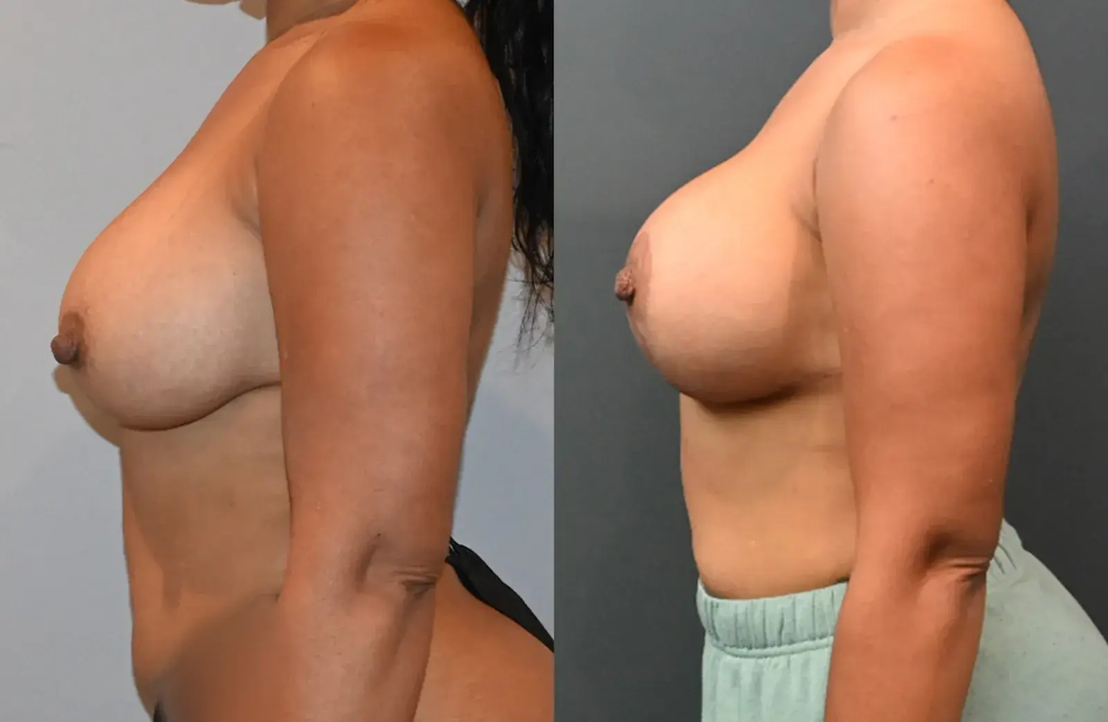 Dr. Brian Shafa Plastic Surgery breast lift result — Beverly Hills, CA