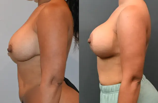 Breast Lift result at Dr. Brian Shafa Plastic Surgery in Beverly Hills, CA