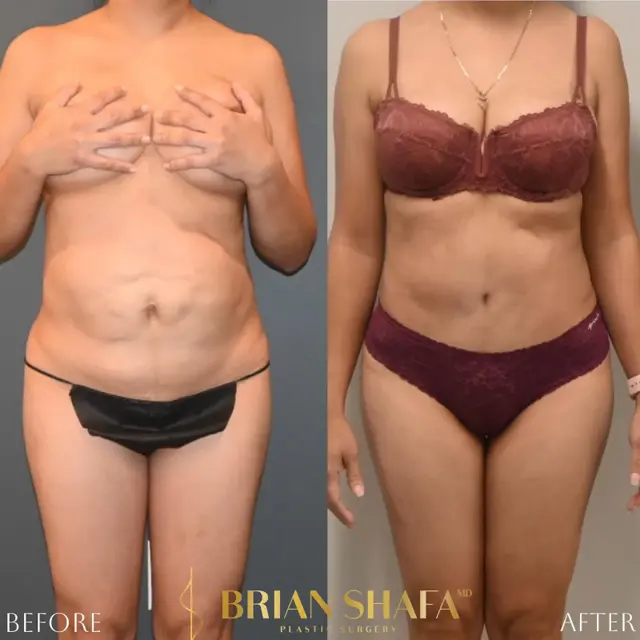 Mini Tummy Tuck result at Dr. Brian Shafa Plastic Surgery in Beverly Hills, CA