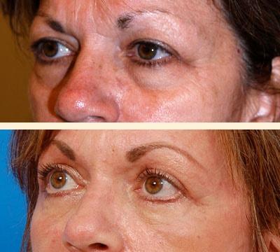Hoefflin Plastic Surgery eyelid lift result — Calabasas, CA