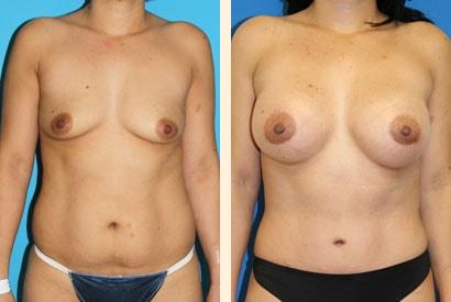 Hoefflin Plastic Surgery mommy makeover result โ Calabasas, CA