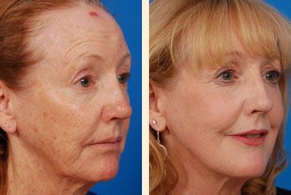 Hoefflin Plastic Surgery laser treatment result — Calabasas, CA
