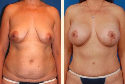 Hoefflin Plastic Surgery mommy makeover result — Calabasas, CA