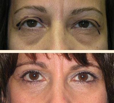 Hoefflin Plastic Surgery eyelid lift result โ Calabasas, CA