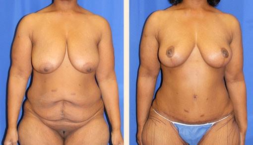 Hoefflin Plastic Surgery mommy makeover result — Calabasas, CA