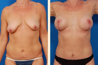 Hoefflin Plastic Surgery mommy makeover result — Calabasas, CA