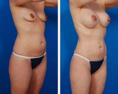 Hoefflin Plastic Surgery mommy makeover result — Calabasas, CA