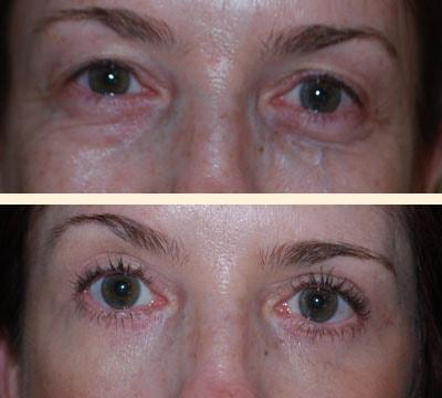 Hoefflin Plastic Surgery eyelid lift result — Calabasas, CA
