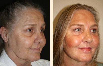 Hoefflin Plastic Surgery laser treatment result โ Calabasas, CA