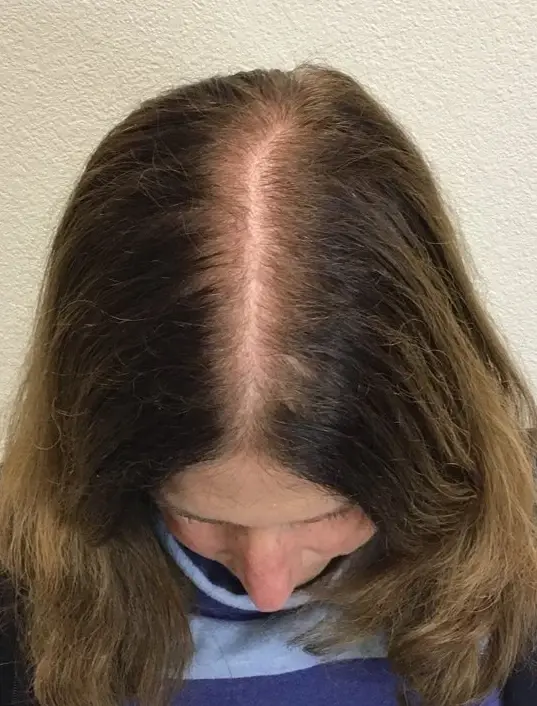 Couture Dermatology & Plastic Surgery hair restoration after — Las Vegas, NV
