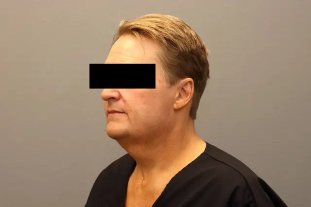 Facelift before at Couture Dermatology & Plastic Surgery in Las Vegas, NV