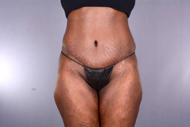 Tummy Tuck after at Couture Dermatology & Plastic Surgery in Las Vegas, NV