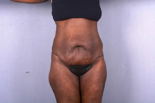 Tummy Tuck before at Couture Dermatology & Plastic Surgery in Las Vegas, NV