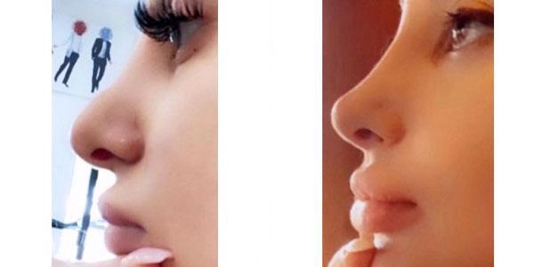 Rhinoplasty result at Ary Krau, MD in Bay Harbor Islands, FL