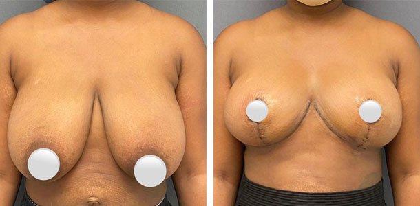 Breast Reduction result at Ary Krau, MD in Bay Harbor Islands, FL
