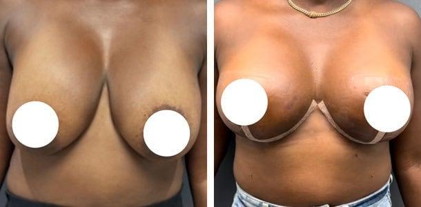 Breast Lift result at Ary Krau, MD in Bay Harbor Islands, FL